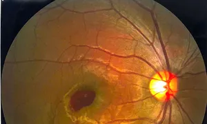 Ánh đèn laser trên sân khấu chiếu thủng mắt chàng trai Ánh đèn laser trên sân khấu chiếu thủng mắt chàng trai
